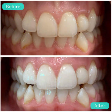 ismile teeth whitening gel